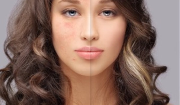 Derm Perfect